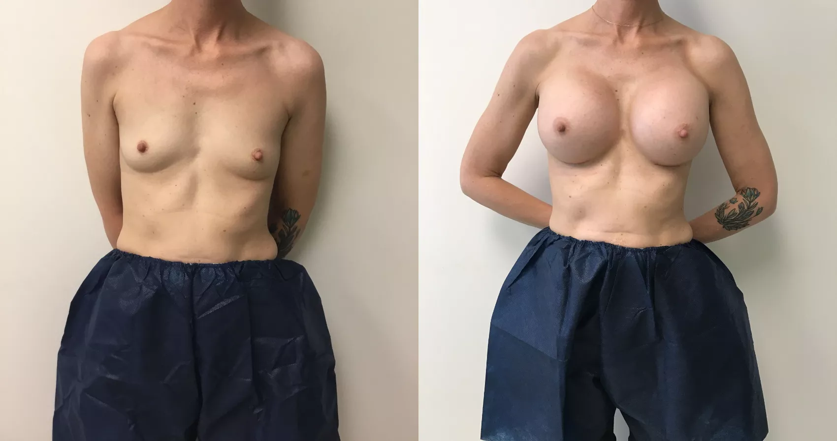 Breast Augmentation
