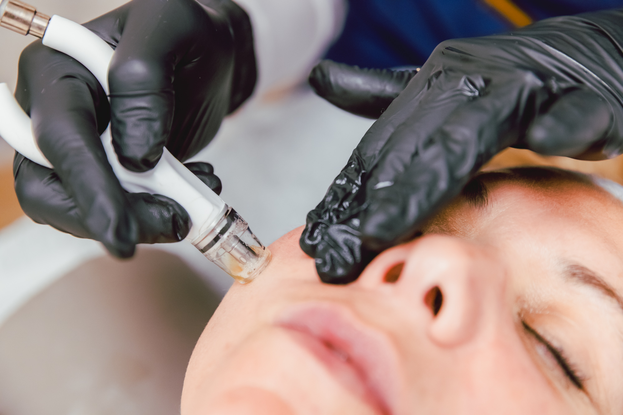 DiamondGlow Dermabrasion