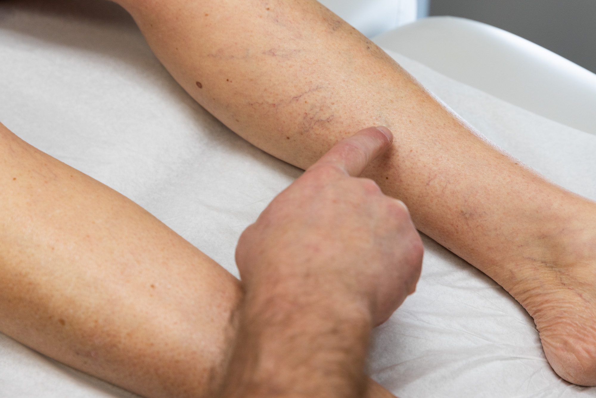 ClearV Laser Vein Treatments