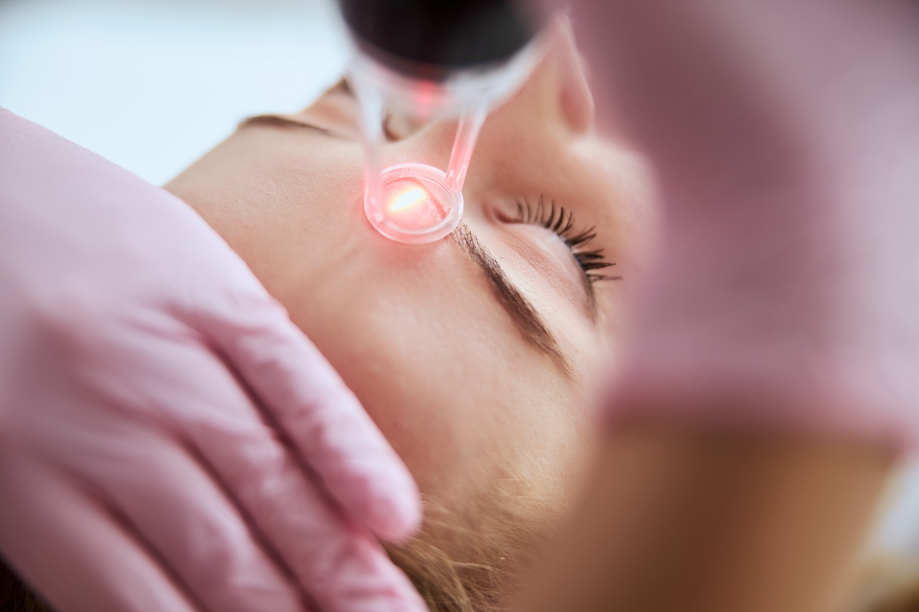 Deep Resurfacing Lasers